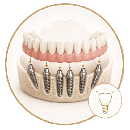 Precise Implant Placement